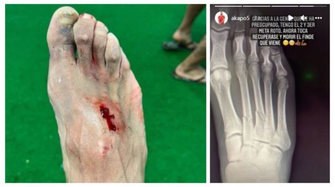 Hazard provoca una doble fractura en el pie de Akapo tras su terrible planchazo